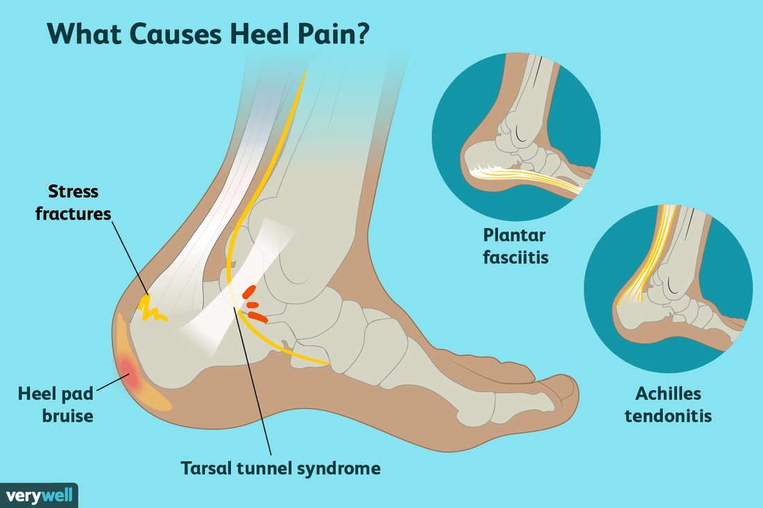 Heel Pain & Plantar Fasciitis Treatment – My FootDr